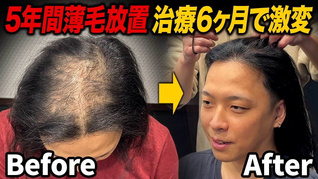 【AGA治療6ヶ月】5年間放置した薄毛が激変！薬を飲みながらお酒は大丈夫！？
