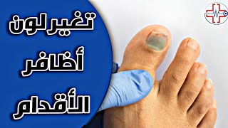 لون أظافر القدم🔵 |  ماذا يخبرك تغير لون أظافر القدم عن جسمك - ورم دموي - سرطان