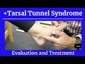 Positive Tarsal Tunnel Syndrome-Eval and Treatment!