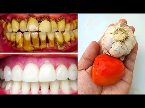 Video: 3 modi per proteggere i denti dall'usura acida