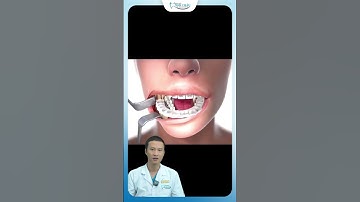 Phẫu Thuật Hàm Niềng Răng | Bác Sĩ Yên