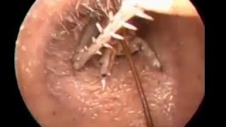 Insects inside the human body Best of compilation2015