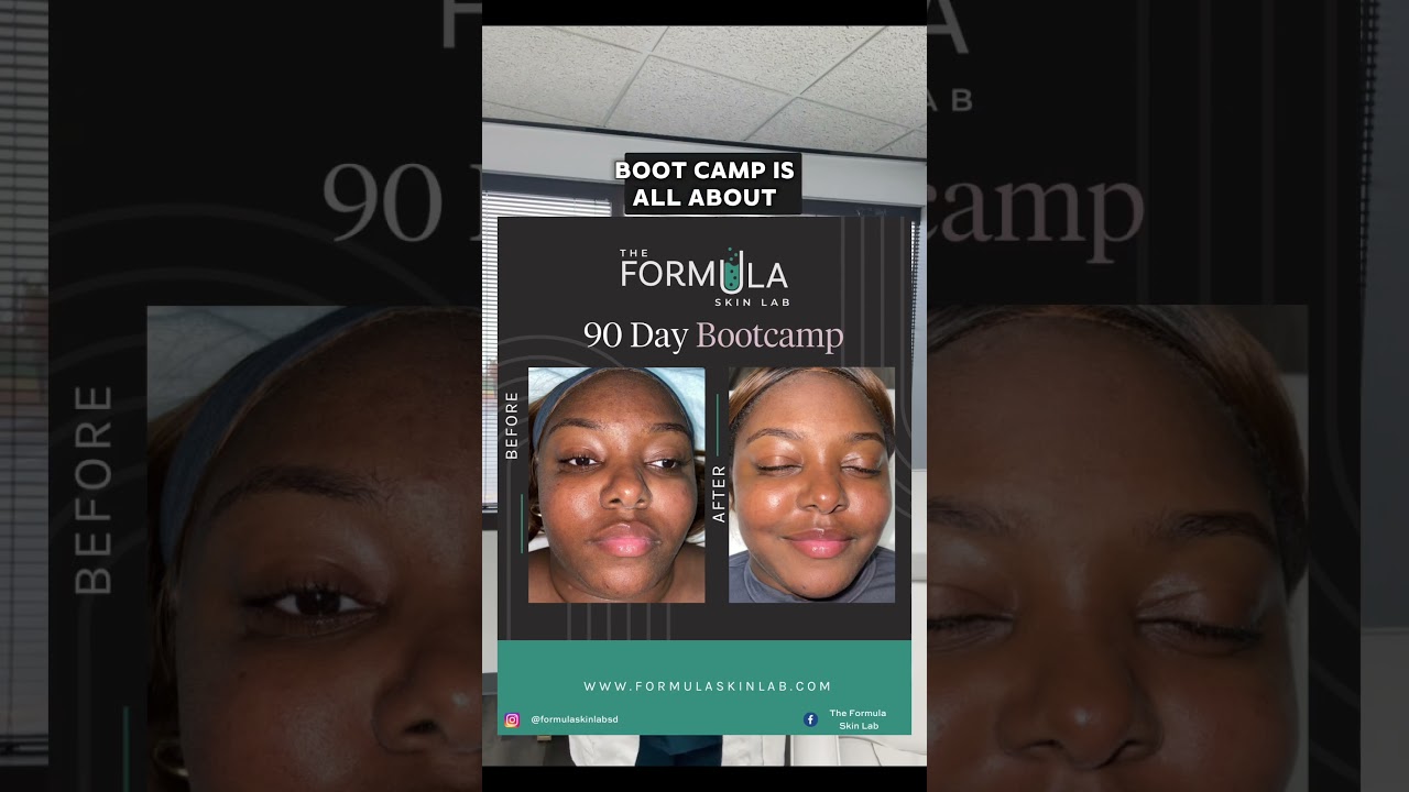 ✨90-Day Acne Bootcamp | Clear Your Skin FAST – Virtual & San Diego, CA!✨