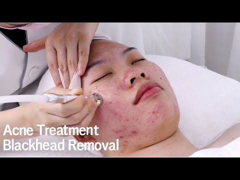 At-Home MicroDermabrasion: Does it work?! Blackhead Removal Acne Treatment | NF108 myChway