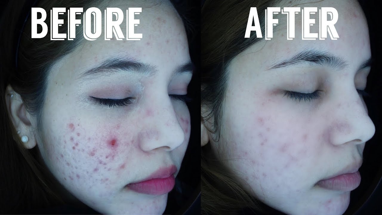 My 3rd Laser for ACNE Does it help? YouTube