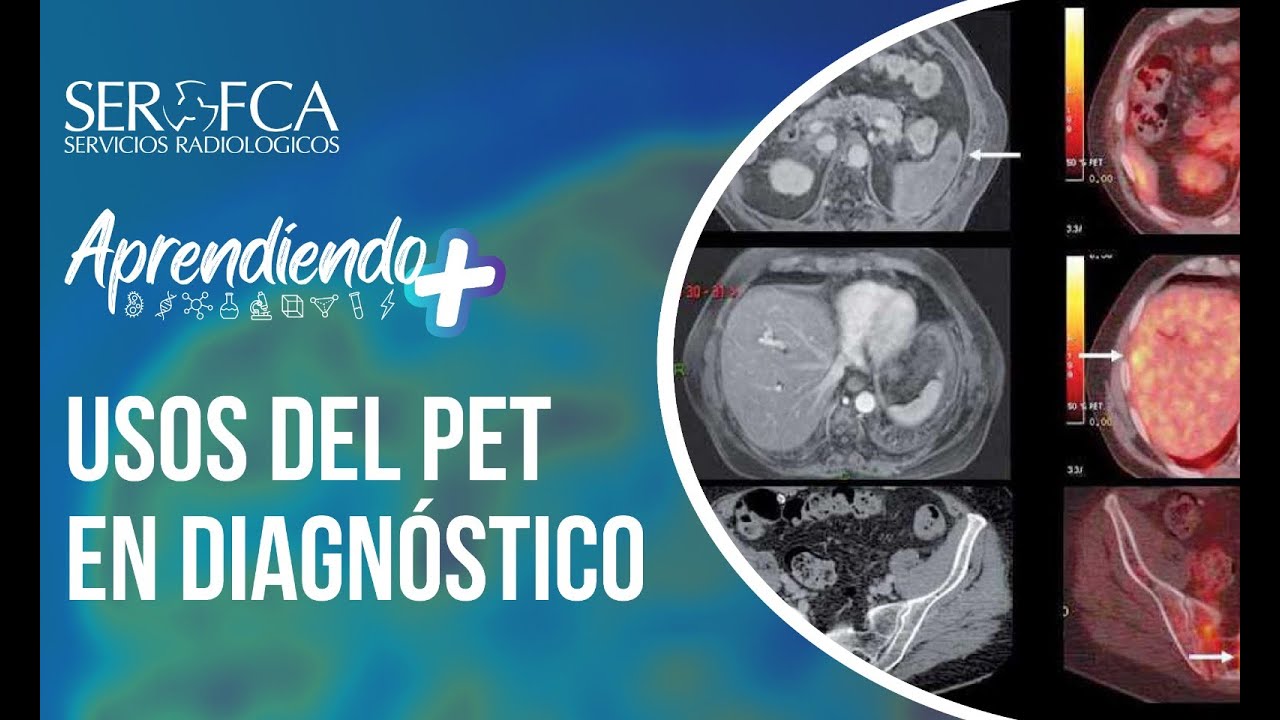 ¿Cómo funciona un ciclotrón en medicina nuclear?