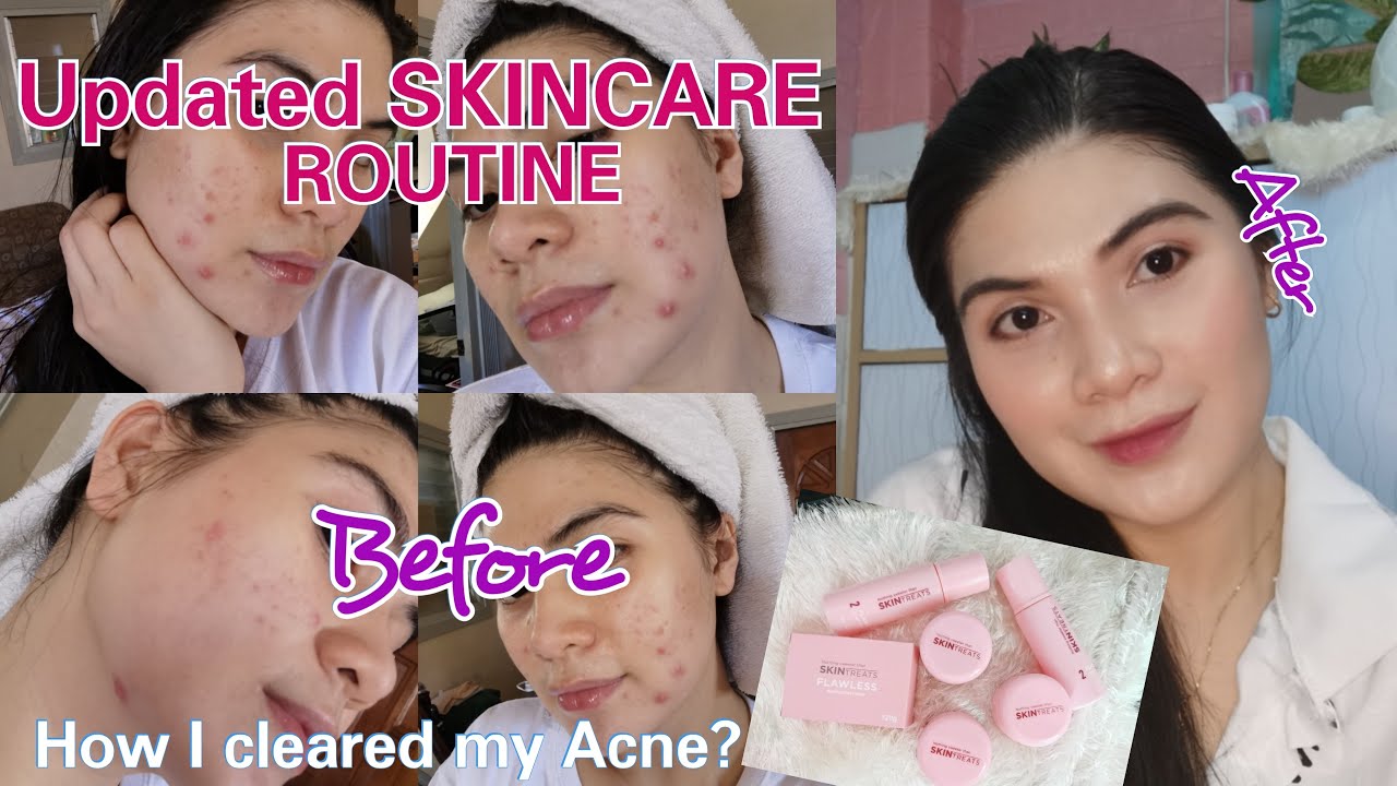 MY SKINCARE ROUTINE | How I Cleared My Acne & Pimples in just One Month ...