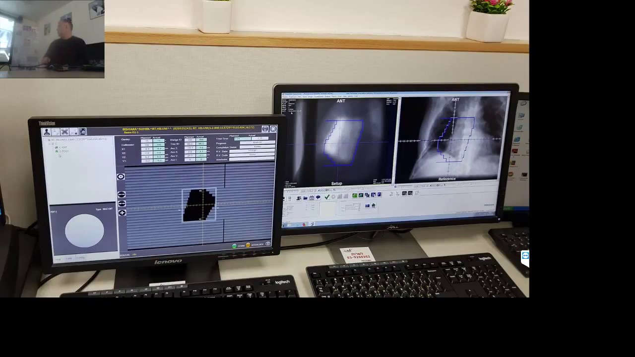 Адаптивная брахитерапия рака предстательной железы (24 апр. 2018 г ...