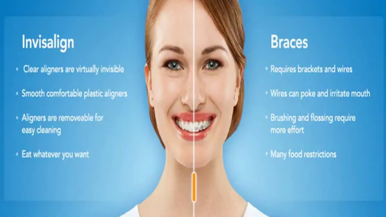 Best Middleburg Heights Invisalign Dentist Near Me YouTube