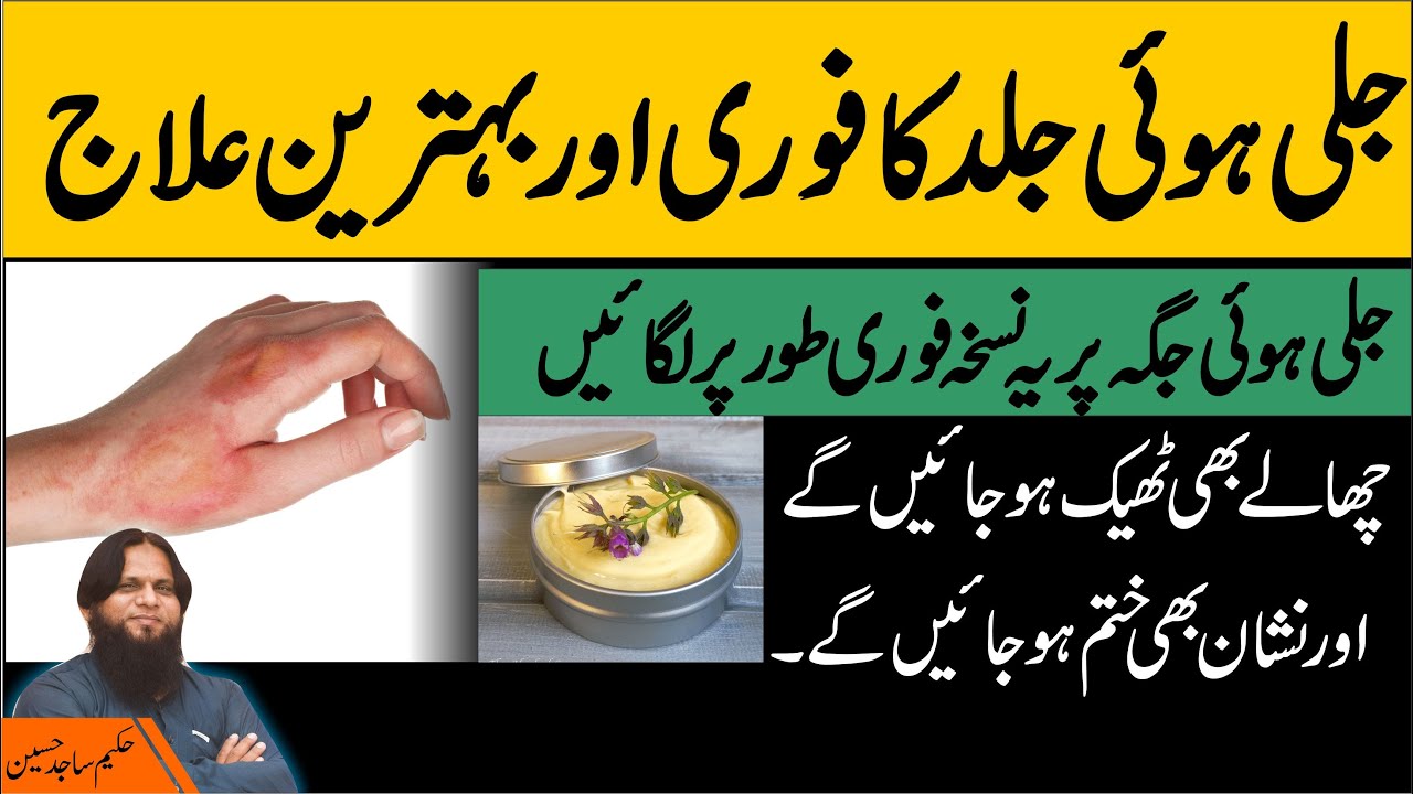 Skin Burn Home Remedy l Jale Howe Zakham Ka Ilaj Gharelo Totka l