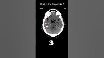 Single slice caution CT brain Acute CT Brain CT quality and artifacts 46 #@radiologychannel007