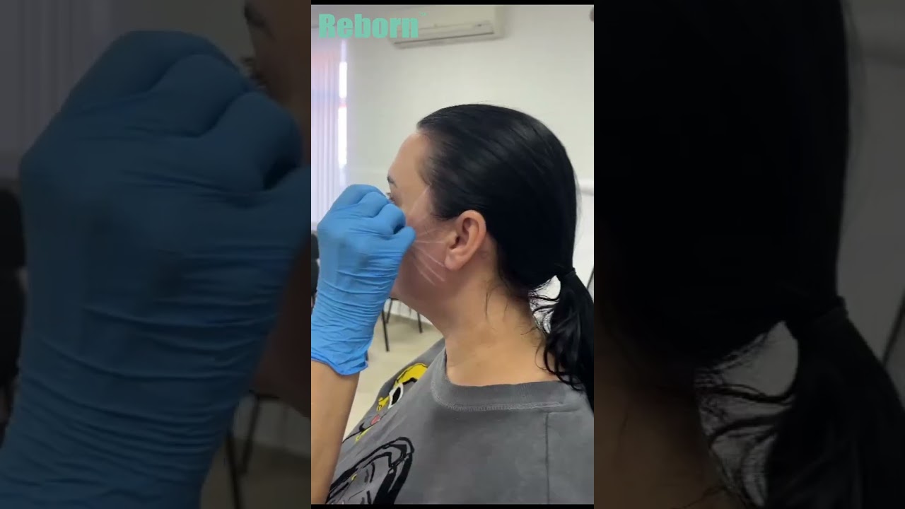 Design Scheme on Cheek Before Injection of Reborn PLLA Dermal Filler