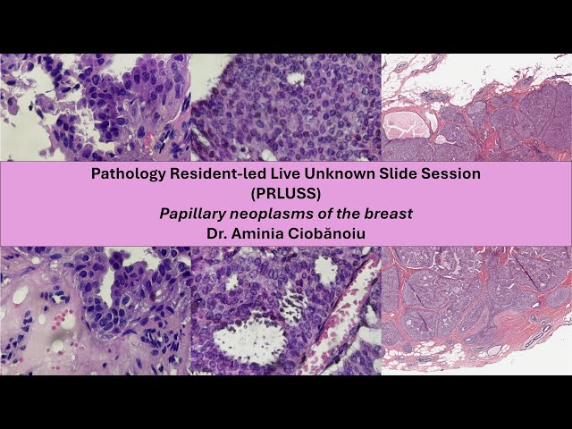 Pathology Resident-led Live Unknown Slide Session (PRLUSS) - Papillary Tumors of the Breast
