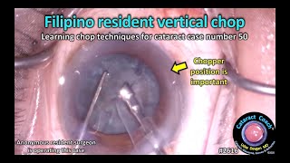 Cataractcoach 2616 Filipino Resident Vertical Chop