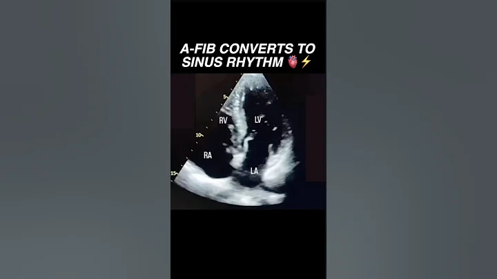 Atrial Fibrillation spontaneously converts to Sinus Rhythm #echo #radiology #cardiology #science