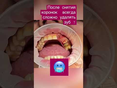 Очень сложный зуб 🥶😱#шортс #москва 🥵#зубы 😨