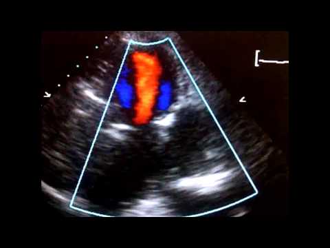 Large LV Pseudoaneurysm - PLAX view | Doovi