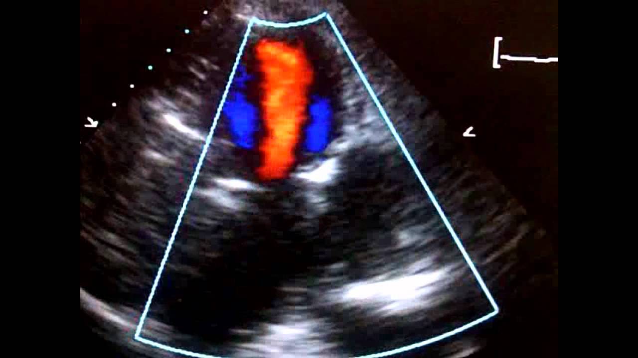 Echocardiogram- Pseudoaneurysm Inferolateral LV - YouTube
