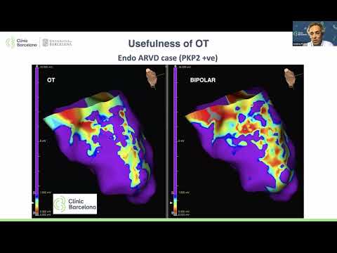 Análisis de EKGs: su importancia en la identificación de mecanismos arritmogénicos - Dr. Andreu Porta