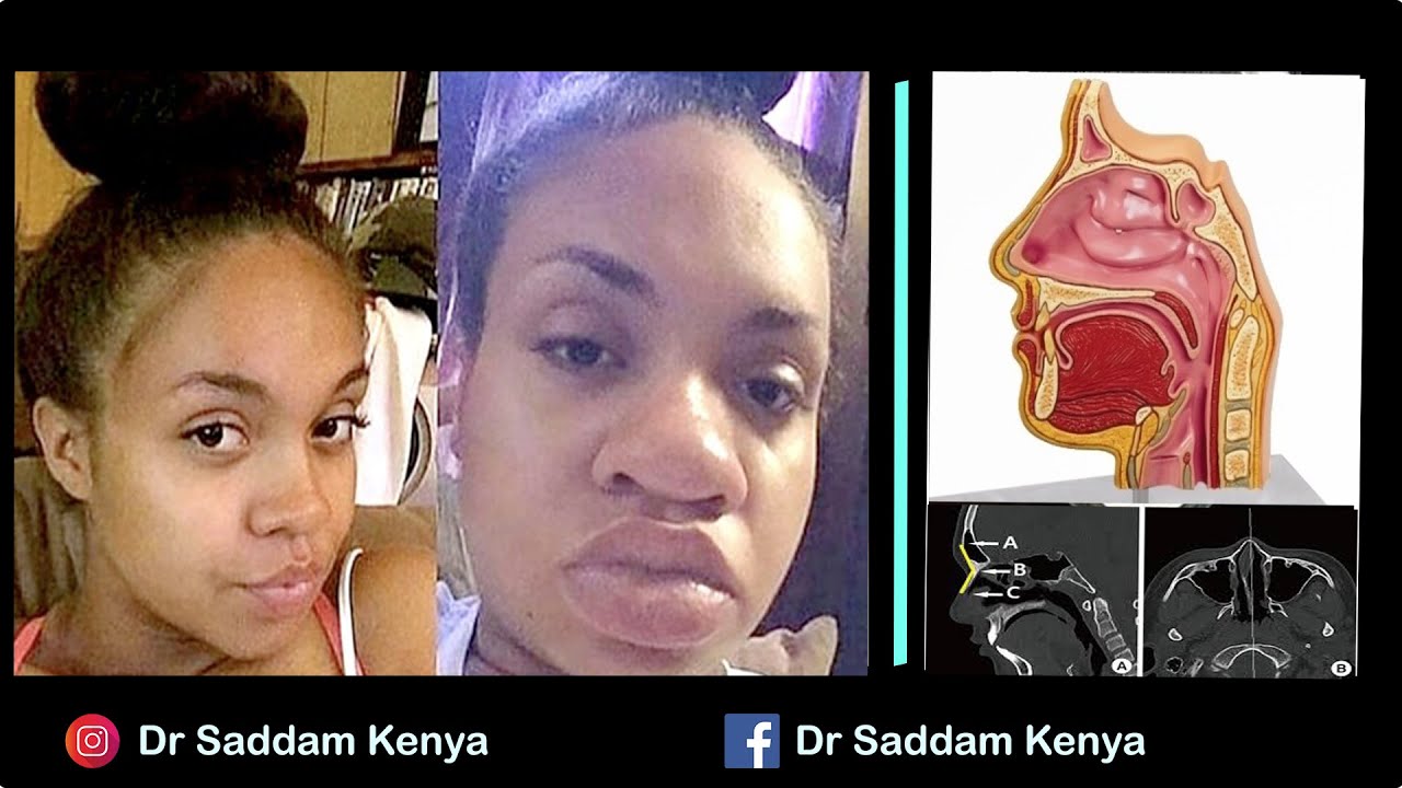 Sababu za kufura / kuvimba kwa pua kwa mjamzito . Kuvimba uso kwa mama