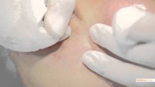 Acnebehandeling - De Huidkliniek