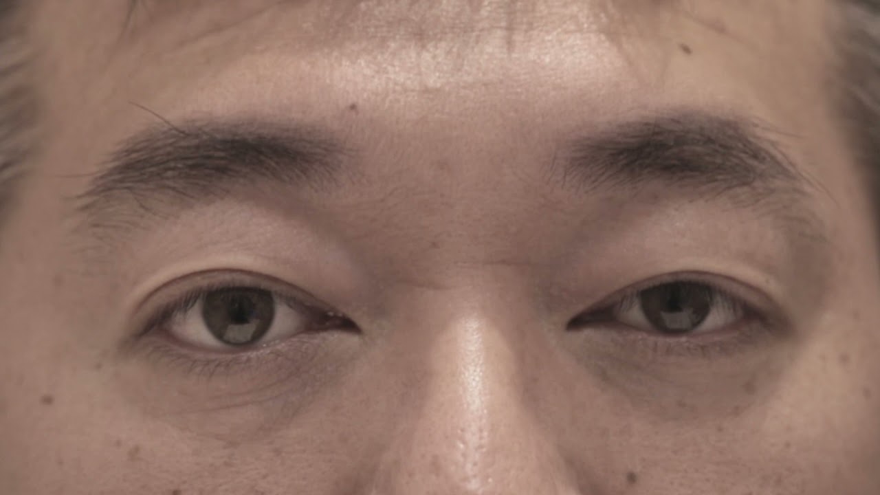 先天性眼瞼下垂症の治療とその効果の限界 費用について まぶたのお医者さん 眼瞼下垂専門の形成外科医