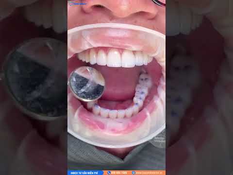 🦷Kiểm tra khớp