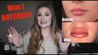 My FREE Lip Injections - STORYTIME