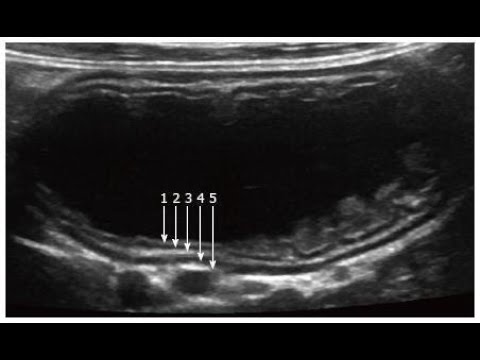 Case 155 : US in GI tract , Normal Anatomy
