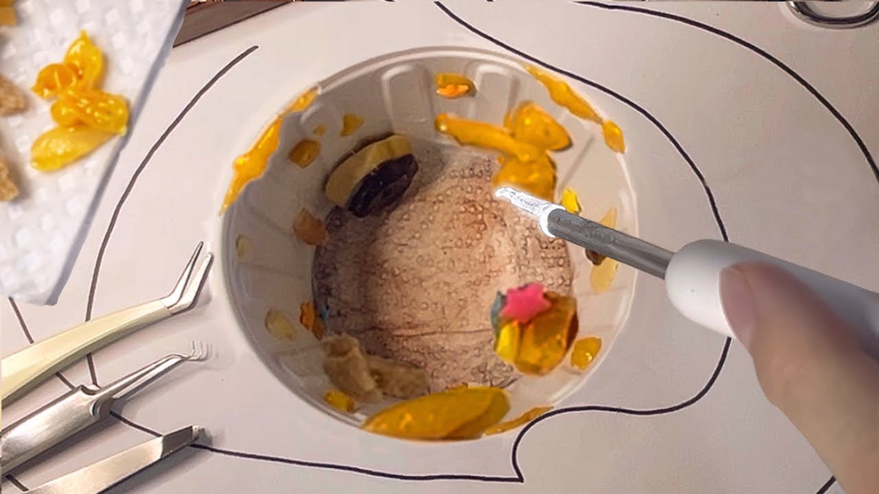 👩🏻‍⚕️축축 환자분, 끈~적한 귀지 제거해드릴게요👂💦 ASMR