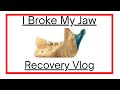 I Broke My Jaw | Surgery, Recovery And What To Expect