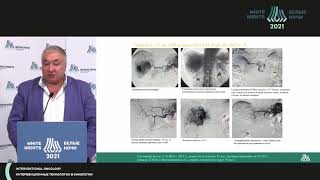 Treatment of patients with intermediate stage HCC (BCLC stage B)  (Aleksey Polikarpov)