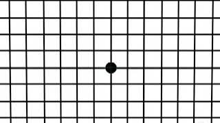 3   Amsler Grid Test