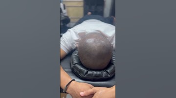 Cận cảnh xăm tóc sau gần 2 năm tại vnscalp điều nhiều người quan tâm,