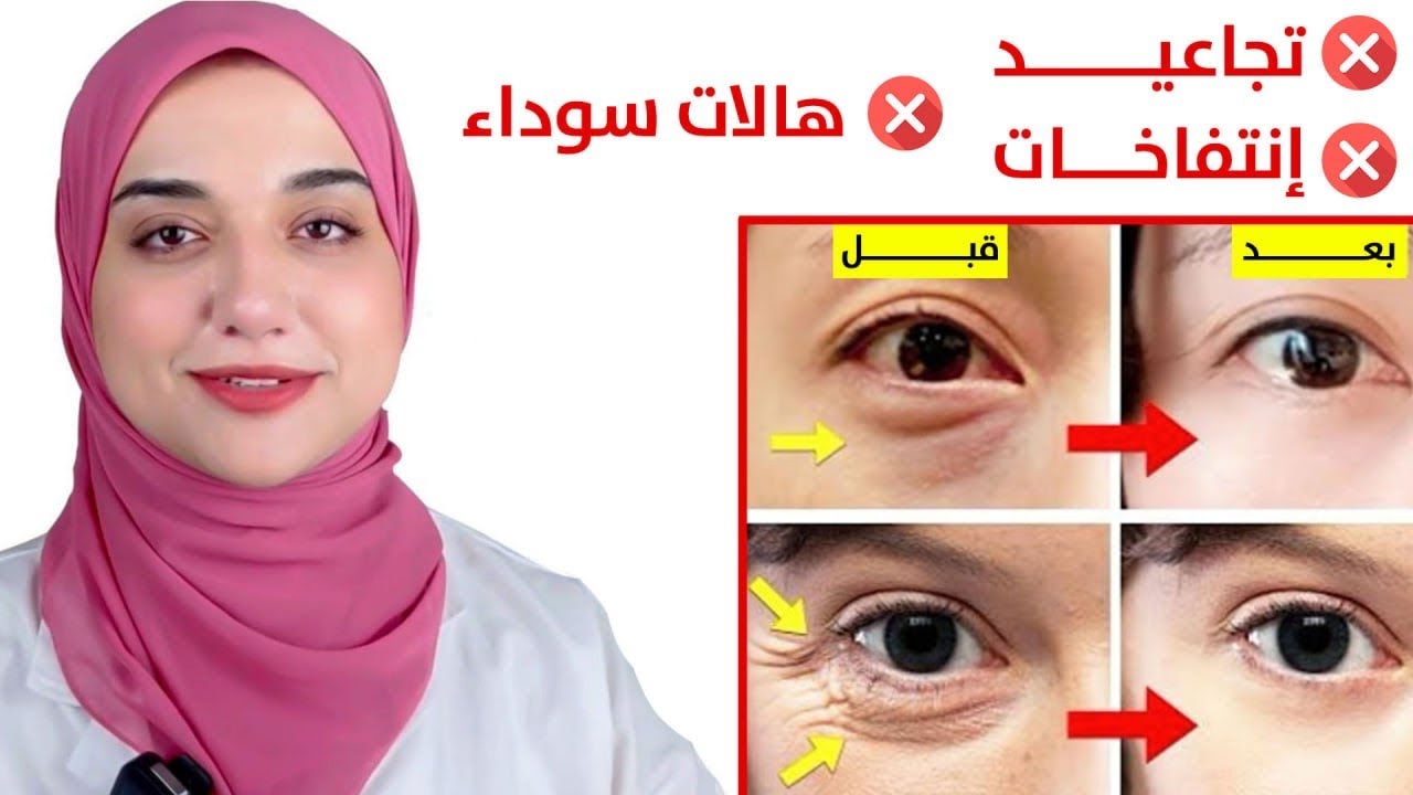 اقوى علاج للتخلص من التجاعيد تحت العين و الهالات السوداء و الانتفاخات بسرعة