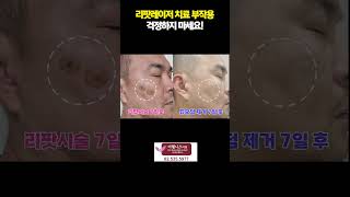 리팟레이저 치료 부작용 걱정하지 마세요!? #흑자치료 #리팟레이저후붉음증 #리팟레이저후저색소증