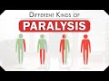 Different Kinds of Paralysis | How Does Someone Become Paralyzed | Types of Paralysis | SRIAAS