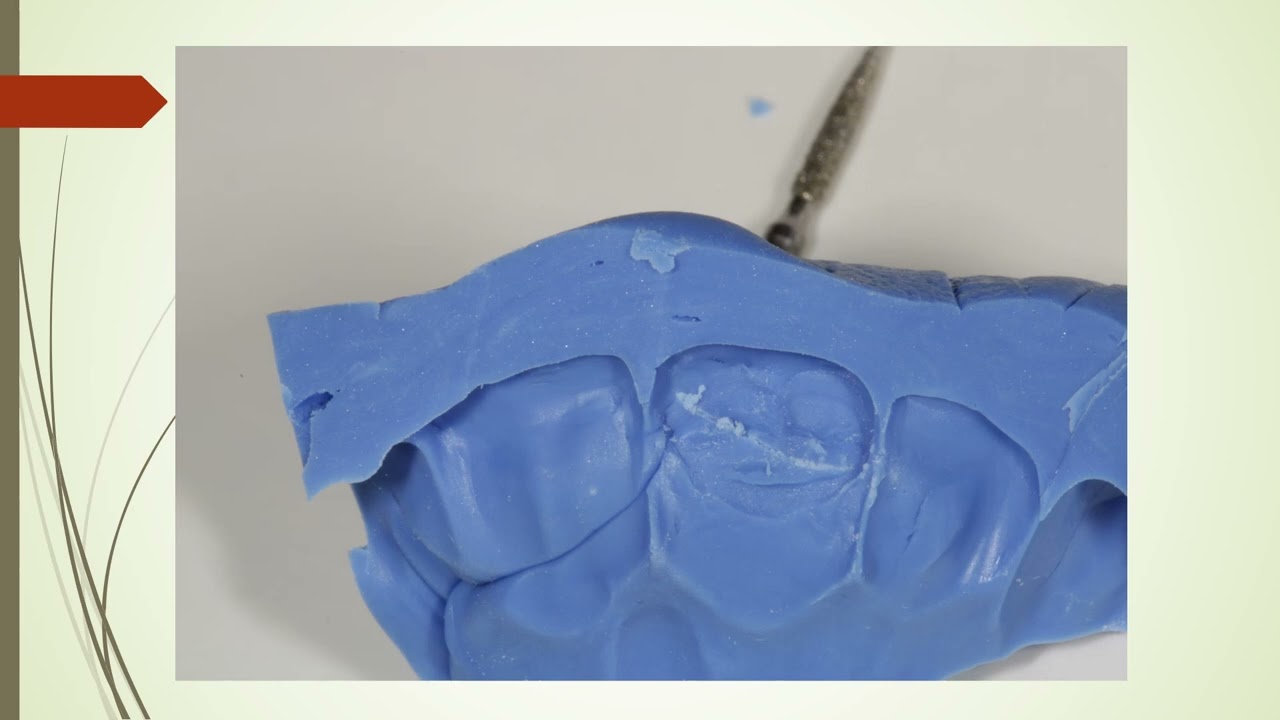 Mascherina diretta per ricostruzione incisivo