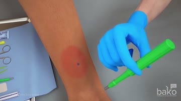 Epidermal Nerve Fiber Density (ENFD) Testing Procedure