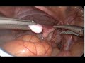 laparoscopic orchidopexy