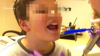 Tratamiento para el Rotacismo con NOVAFON