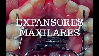 BRACKETS  EXPANSORES MAXILARES  Hyrax  QuadHelix  McNamara