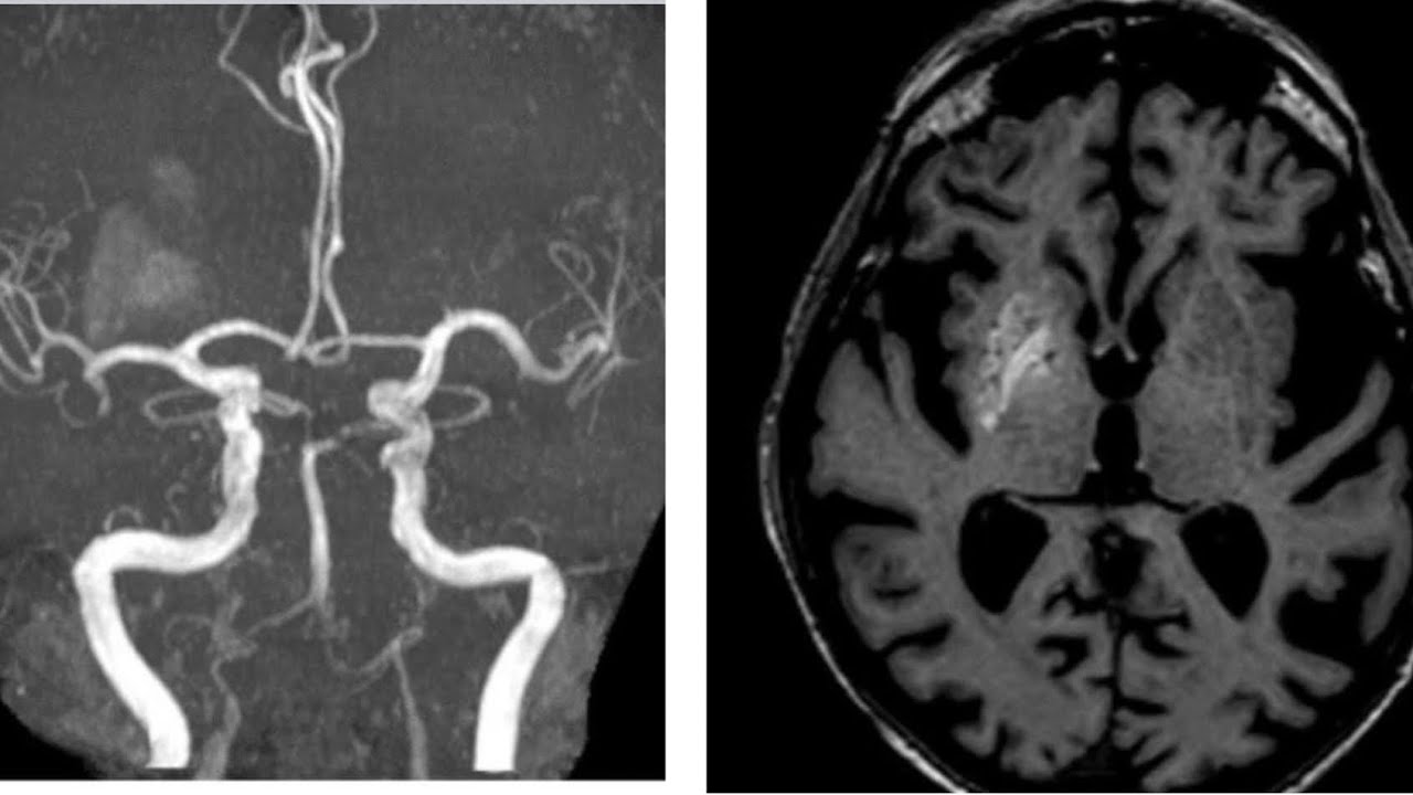 Short Case Discussion: Non-ketotic hyperglycaemic hemichorea (NHH)