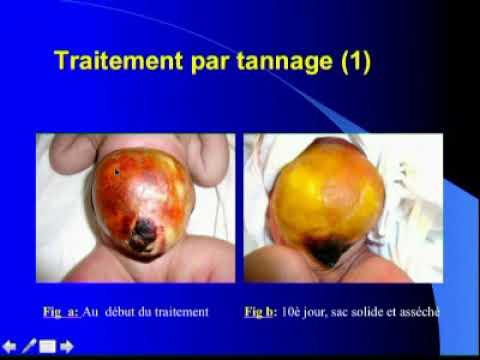 Vidéo: Quelle est la fréquence des omphalocèles ?