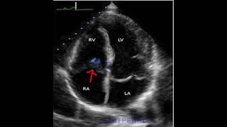 Podcast 762: Endocarditis Podcast 524 Bacterial Endocarditis