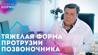 Тяжелая форма протрузия межпозвонковых дисков. Нейрохируг Зорин Николай Александрович