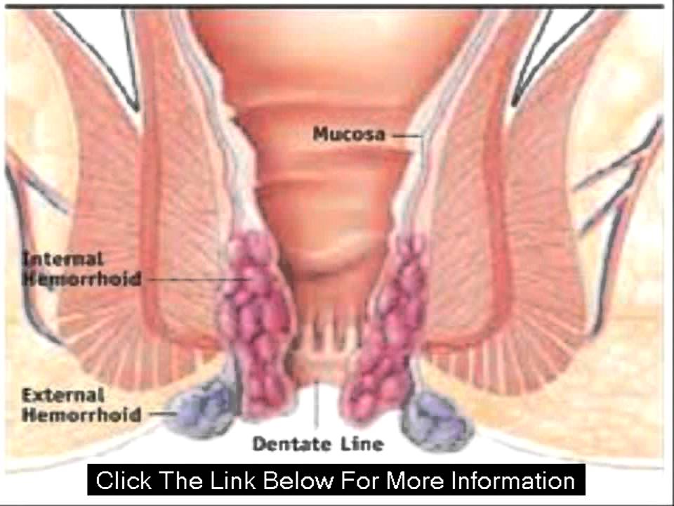 Natural Treatment For Anus Itching Natural Treatment For Anus Itching