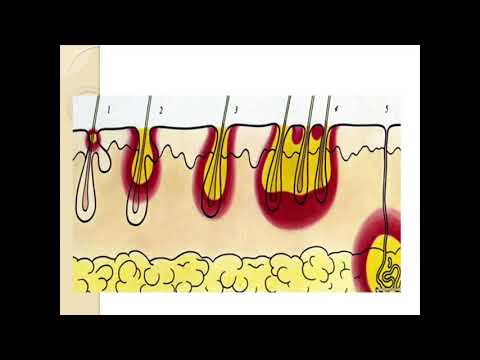 Хирургия полости рта 6.Фурункул и карбункул лица. Рожистое воспаление