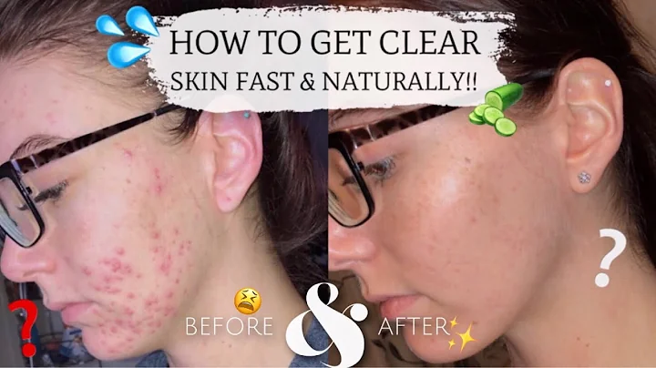 HOW TO ACHIEVE ACNE FREE NATURAL GLOWING SKIN!!! | Cassidy Arvidson