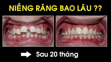 Niềng răng bao lâu thì đẹp?